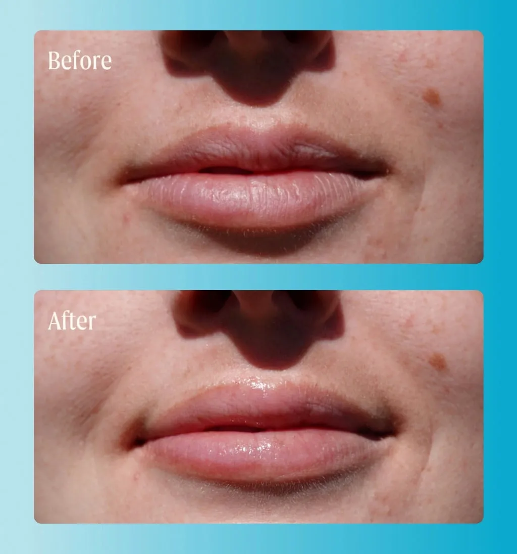 Supermelt Hyaluronic Plumping Lip Treatment